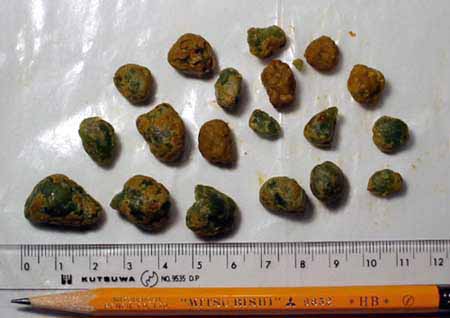 Bile Stones